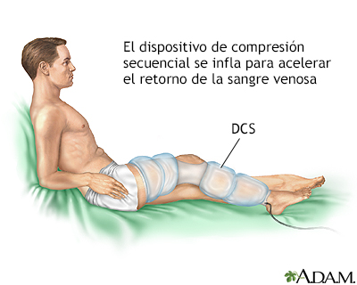 La piedra de varikoza